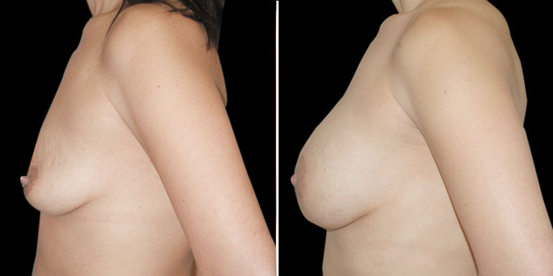 Dr. Kao Breast Lift with Implants
