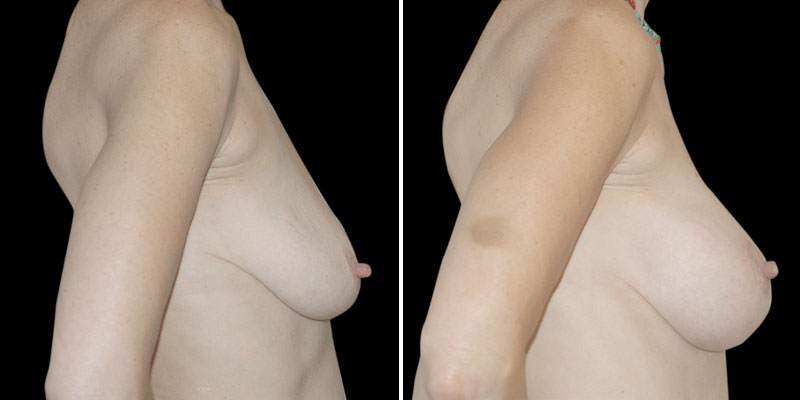 Dr. Kao Breast Lift with Implants