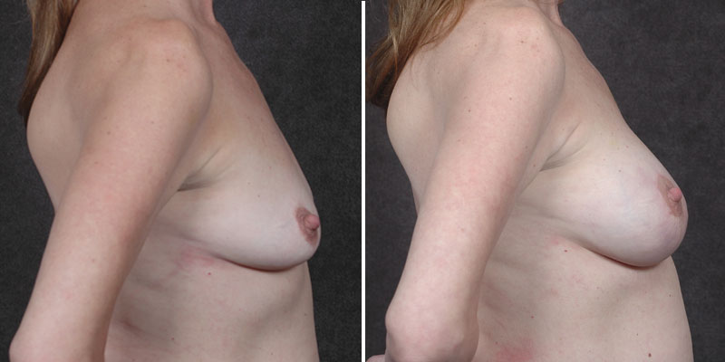 Dr. Kao Breast Lift with Implants