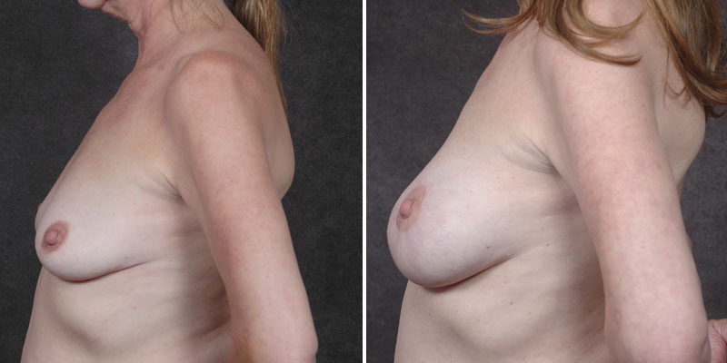 Dr. Kao Breast Lift with Implants