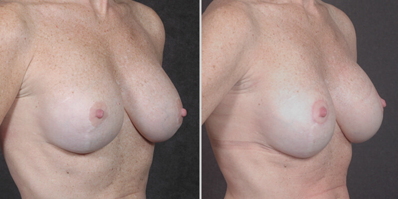 Dr. Kao Breast Implant Revision