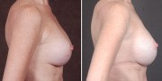 Dr. Kao Breast Implant Revision