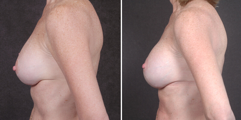 Dr. Kao Breast Implant Revision