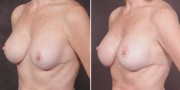 Dr. Kao Breast Implant Revision