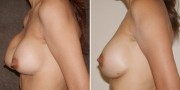Dr. Kao Breast Implant Revision