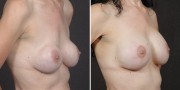 Dr. Kao Breast Implant Revision