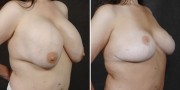 Dr. Kao Breast Implant Revision