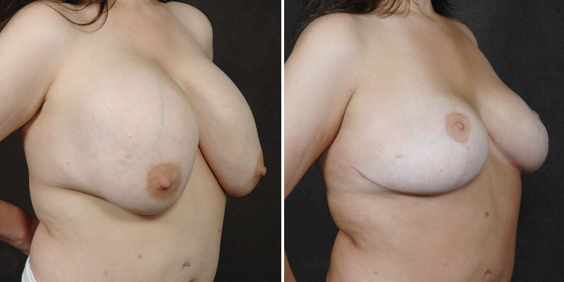 Dr. Kao Breast Implant Revision