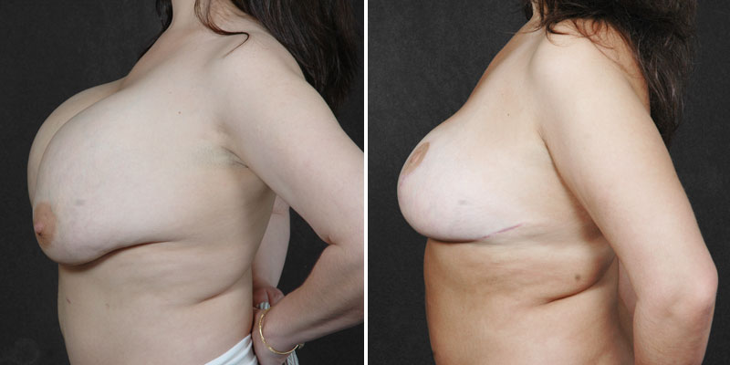 Dr. Kao Breast Implant Revision