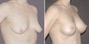 Dr. Kao Breast Lift with Implants