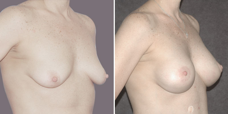 Dr. Kao Breast Lift with Implants