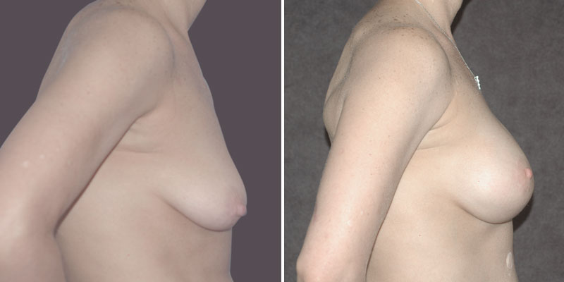 Dr. Kao Breast Lift with Implants