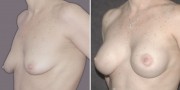 Dr. Kao Breast Lift with Implants