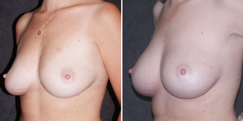 Dr. Kao Breast Lift with Implants