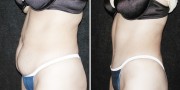 Dr. Kao Tummy Tuck (Abdominoplasty)