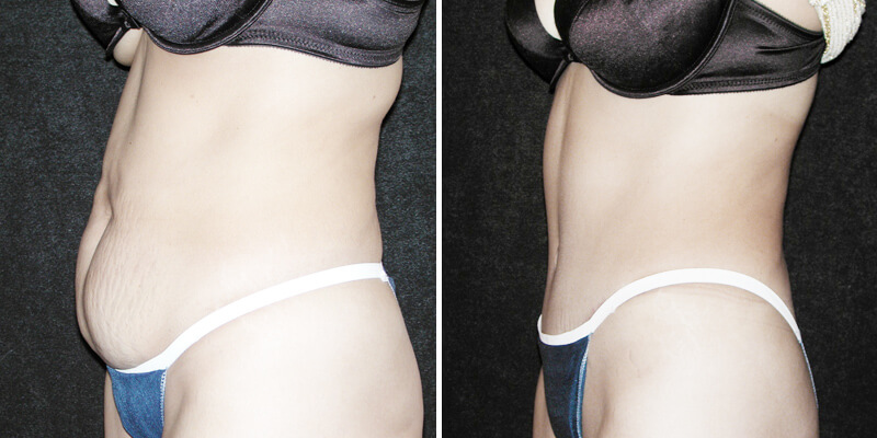 Dr. Kao Tummy Tuck (Abdominoplasty)