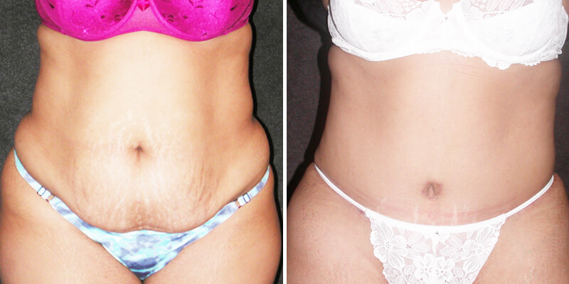 Dr. Kao Tummy Tuck (Abdominoplasty)