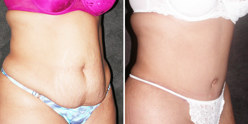 Dr. Kao Tummy Tuck (Abdominoplasty)