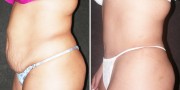Dr. Kao Tummy Tuck (Abdominoplasty)