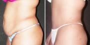 Dr. Kao Tummy Tuck (Abdominoplasty)