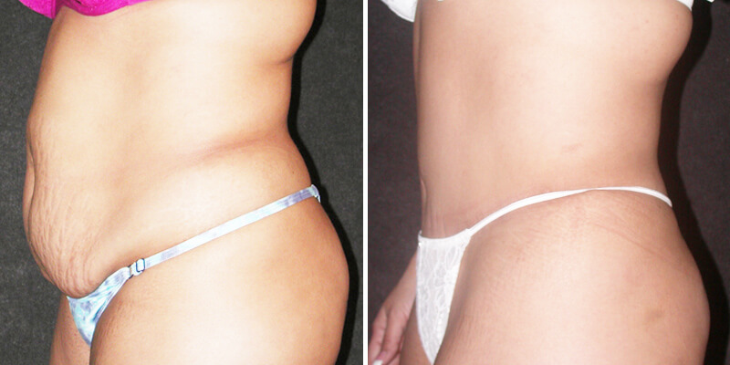 Dr. Kao Tummy Tuck (Abdominoplasty)