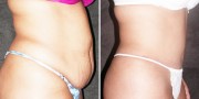 Dr. Kao Tummy Tuck (Abdominoplasty)