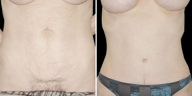 Dr. Kao Tummy Tuck (Abdominoplasty)