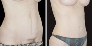 Dr. Kao Tummy Tuck (Abdominoplasty)