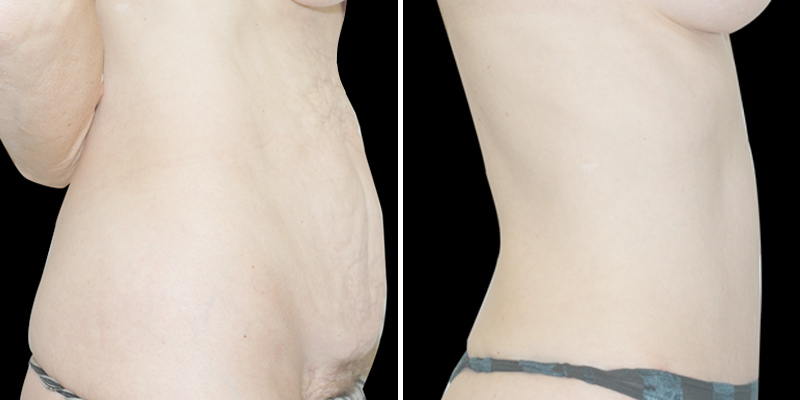 Dr. Kao Tummy Tuck (Abdominoplasty)