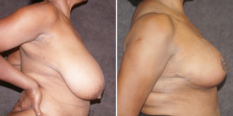 Dr. Kao Breast Reduction