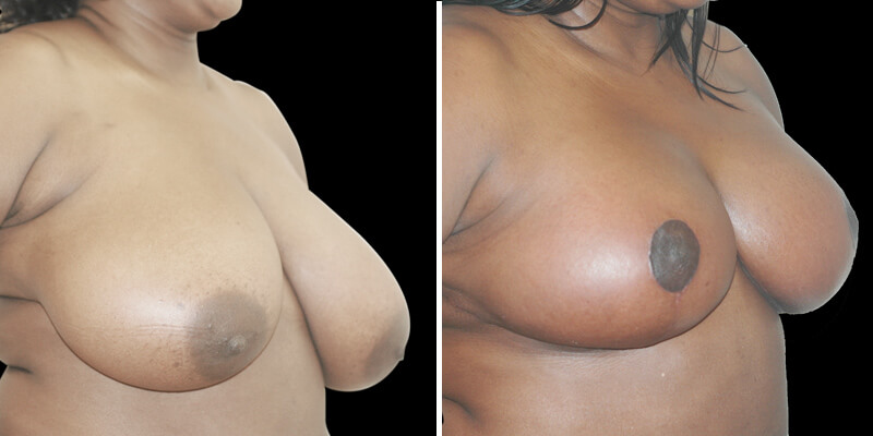 Dr. Kao Breast Reduction