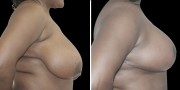 Dr. Kao Breast Reduction