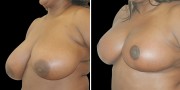 Dr. Kao Breast Reduction