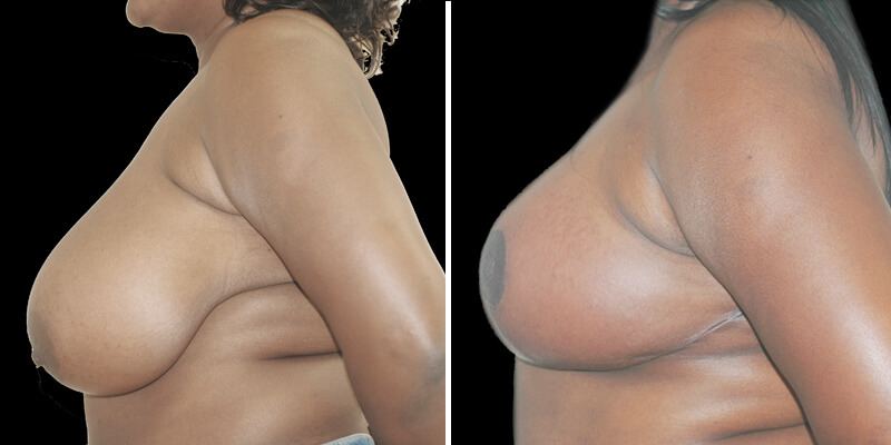 Dr. Kao Breast Reduction