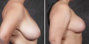 Dr. Kao Breast Reduction