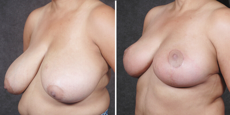 Dr. Kao Breast Reduction