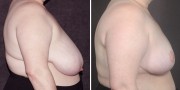 Dr. Kao Breast Reduction