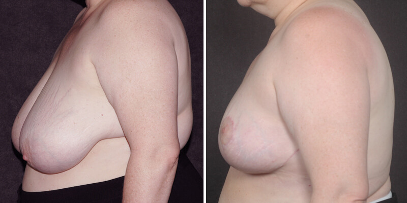 Dr. Kao Breast Reduction