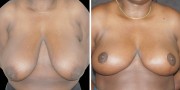 Dr. Kao Breast Reduction