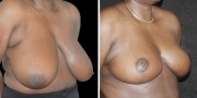 Dr. Kao Breast Reduction