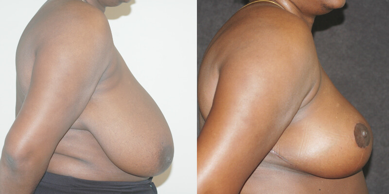 Dr. Kao Breast Reduction