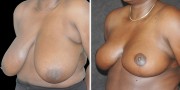 Dr. Kao Breast Reduction