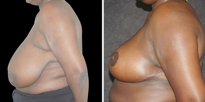 Dr. Kao Breast Reduction