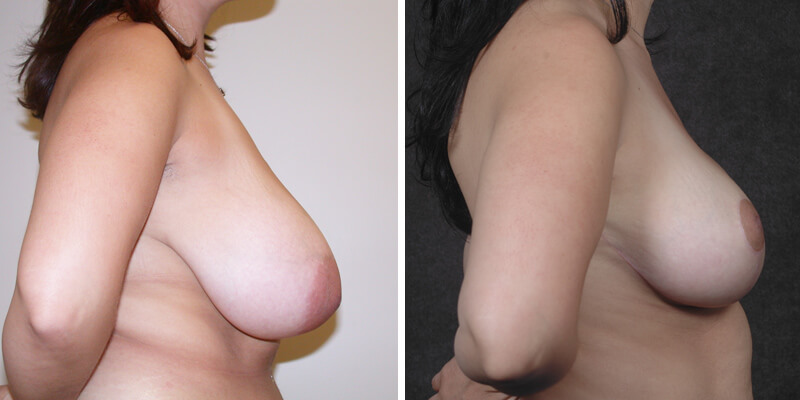 Dr. Kao Breast Reduction