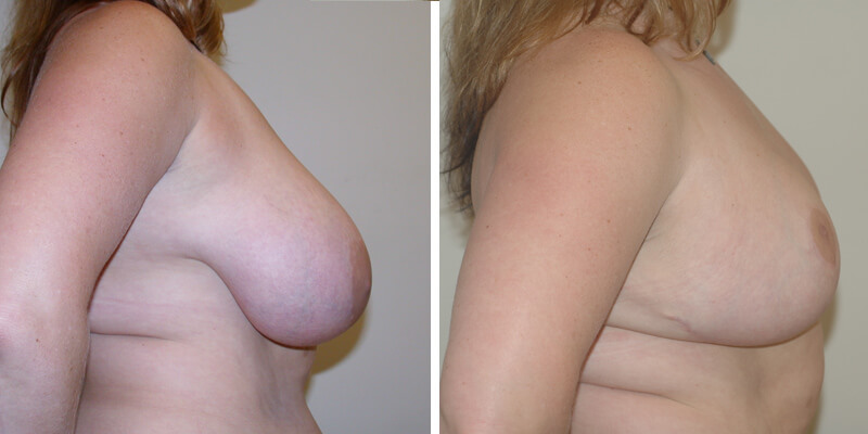 Dr. Kao Breast Reduction