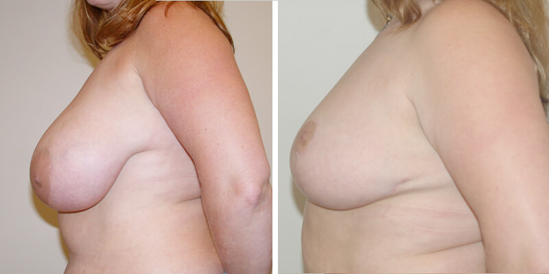 Dr. Kao Breast Reduction