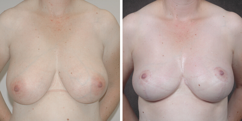 Dr. Kao Breast Reduction