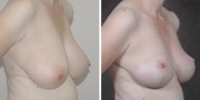 Dr. Kao Breast Reduction