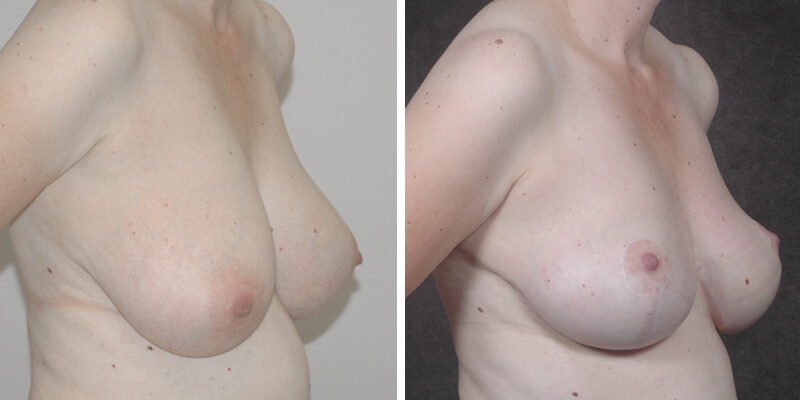 Dr. Kao Breast Reduction