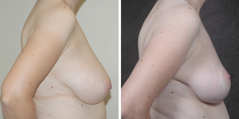 Dr. Kao Breast Reduction